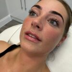 lipfiller