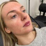 lipfiller3