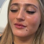 lipfiller7