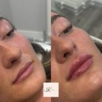lipfiller8