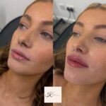 lipfiller9